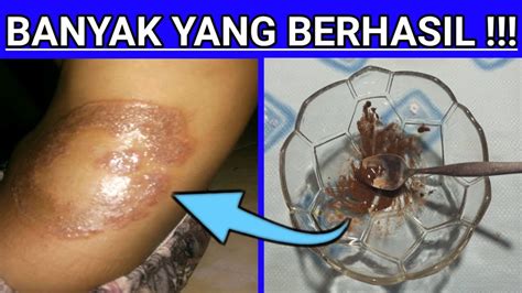 Adapun beberapa cara ampuh untuk mengatasinya 2. Obat Alami Penyakit Kulit Kadas, Kurap Dan Kudis Paling ...