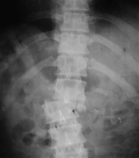 Backbones are typically fiber optic trunk lines. Spine Injuries Xrays and Photographs | Bone and Spine