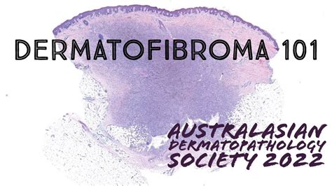 Dermatofibroma 101 ‪dermatology Pathology Dermpath Usmle Youtube