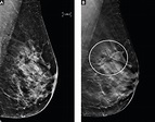 Breast cancer screening: Does tomosynthesis augment mammography ...