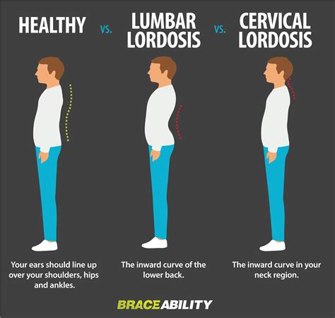 Cervical Lordosis Exercises