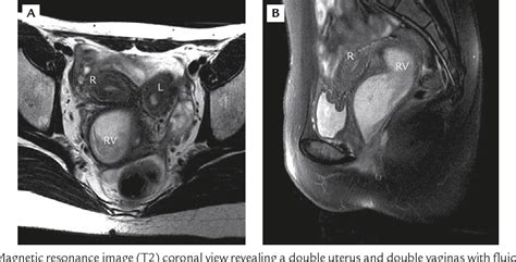 Pdf Uterus Didelphys With An Obstructed Unilateral Vagina And My XXX