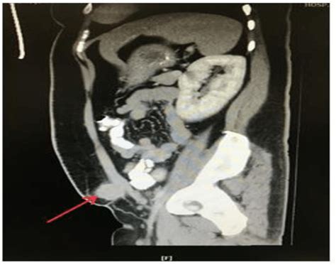 Abdominal Wall Mass Seen On Ct Scan Sagittal View Arrow Download