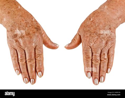 Blood Spots On Hands Hi Res Stock Photography And Images Alamy