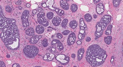 Adenoid Cystic Carcinoma Of The Breast Atlas Of Pathology