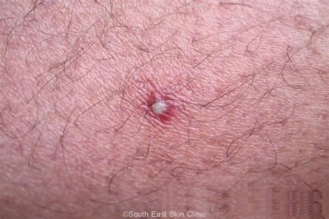 Folliculitis A Term Many Australians Are Familiar With But Why