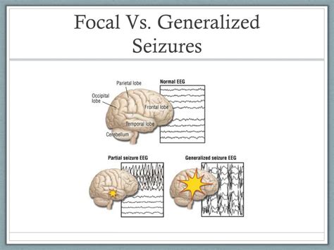Ppt Epilepsy And Seizures In Adults From Diagnosis To Treatment And
