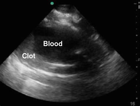 Blood Clot In Uterus During Early Pregnancy Pregnancywalls
