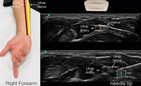 Ultrasound Guided Blocks Of The Median Ulnar And Radial Nerves Otosection