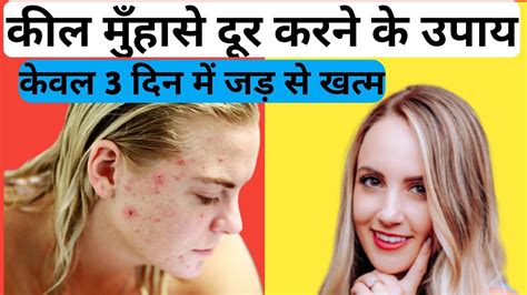 Acne Treatment Kil Muhase Dur Karne Ke Upay Youtube
