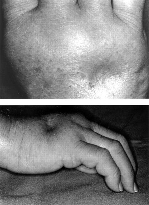 Polyarthritis And Pitting Oedema Annals Of The Rheumatic Diseases