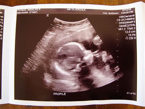 Baby Boy 2s 20 Weeks Ultrasound Sweet Annas