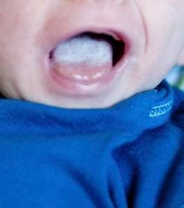 Use a piece of soft gauze or cotton cloth to dip into warm water and clean the tongue. Is That Really Thrush on Your Baby's Tongue? - Milk ...