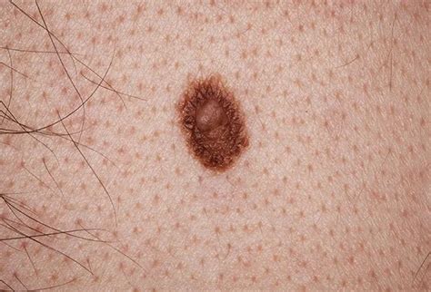 Picture Of Compound Nevus Picture Image On