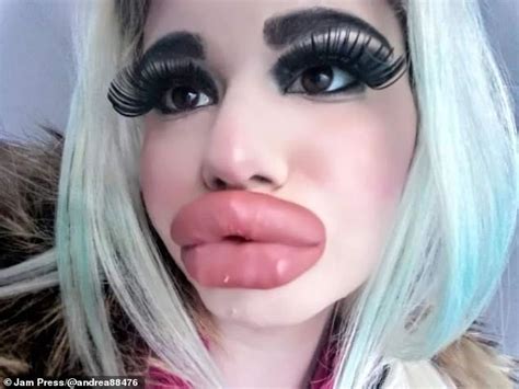 Exclusive Woman With World S Biggest Lips Is Now Getting The World S Biggest Cheeks