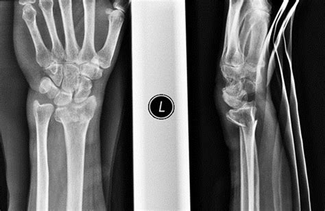 Signs Of Wrist Fracture In Child Dobrilo