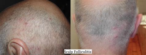 Scalp Folliculitis Cure And Treatment