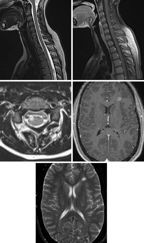 Multiple Sclerosis Ms The Neurosurgical Atlas