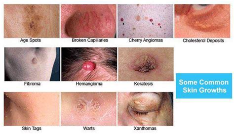 Common Skin Growths A Dermatologists Perspective