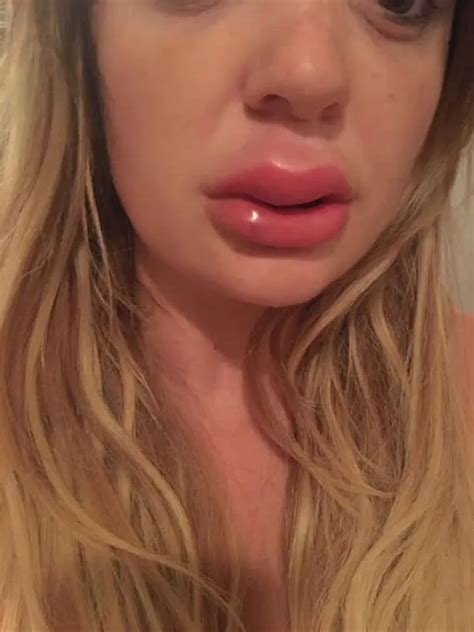 Extremely Swollen Lips After Filler Lipstutorial Org