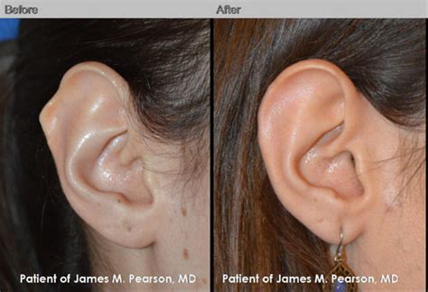 Before And After Photos Photo Gallery Dr James Pearson Facial Plastic