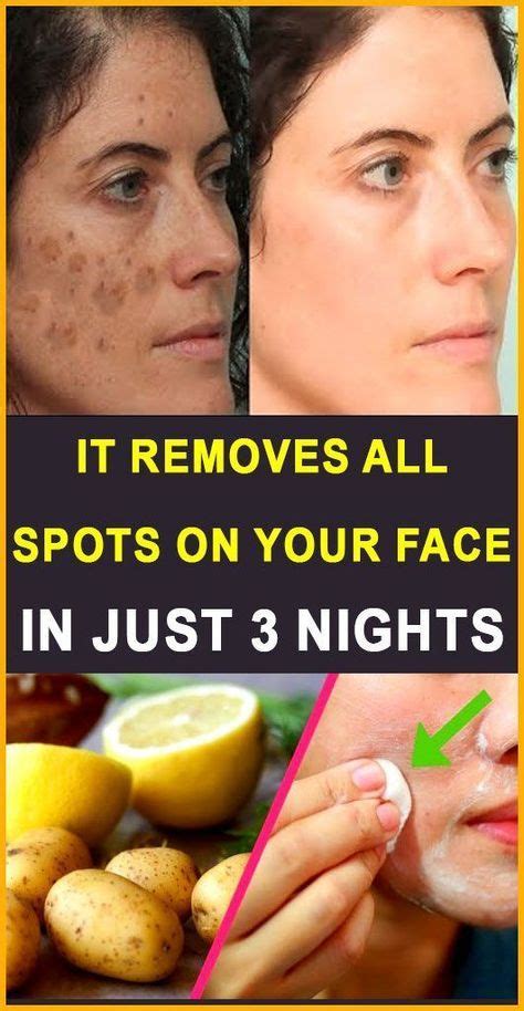 30 Natural Home Remedies To Remove Acne Scars Overnight