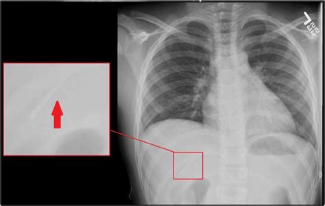 Chest X Ray Demonstrating A Foreign Body Windowed In The Right Upper
