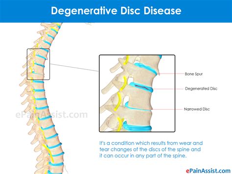 Types Of Degenerative Disc Disease Its Symptoms Treatment Pathophysiology