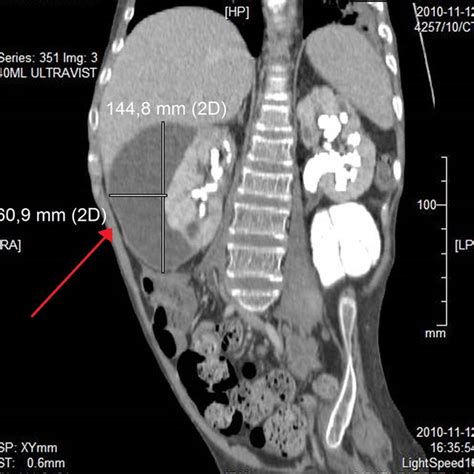 Ct Scan Of The Abdomen A Large Amount Of Fluid Of 11 58 Hounsfield