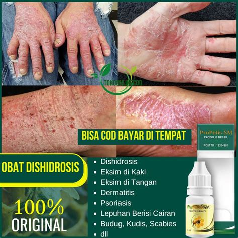 Jual Obat Dishidrosis Eksim Di Kaki Dan Tangan Dermatitis