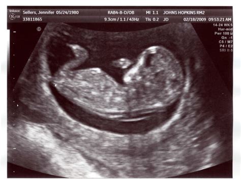 We did not find results for: 11 week ultrasound 3 | chadsellers | Flickr