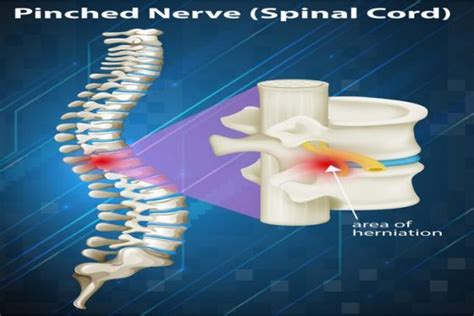 Pinched Nerve Symptoms Causes Diagnosis Management And Treatment