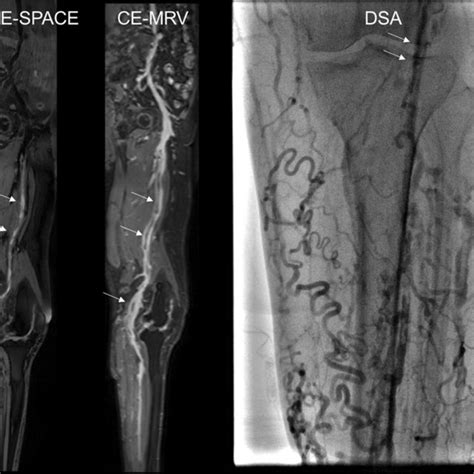 Mri And Dsa Images Of A 61 Year Old Male With Right Lower Extremity