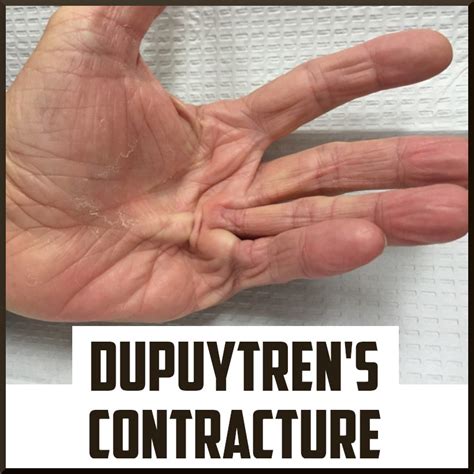 Review On Dupuytrens Contracture Sports Medicine Review