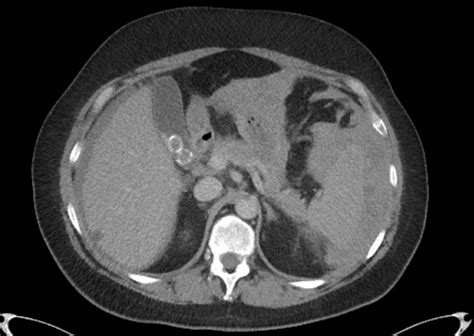 Ct Scan Of The Abdomen Showing A Splenic Rupture And Free Download