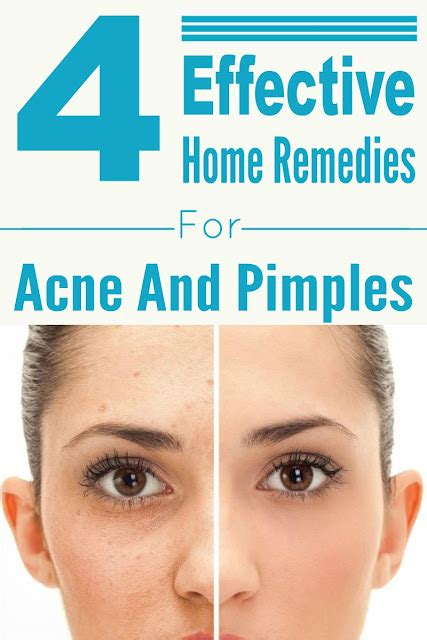 4 Effective Home Remedies For Acne And Pimples