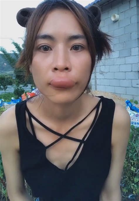 Top Lips Of Chinese Woman Swell Like Sausage After Being Stung By Bee