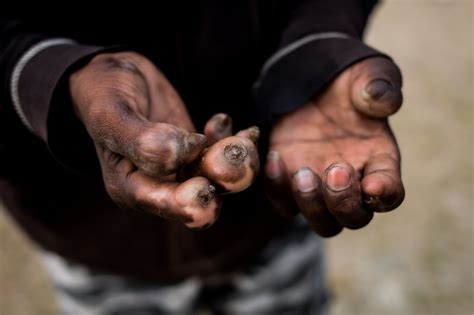 Ed Hanley Documenting Leprosy In India