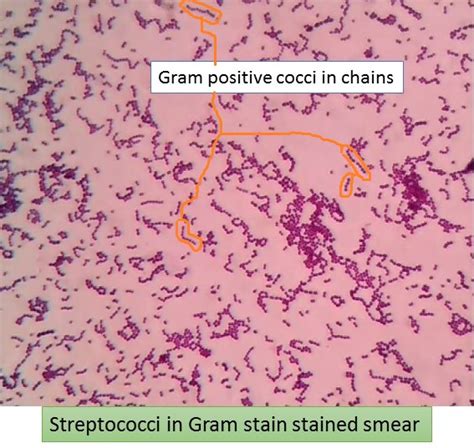 Streptococci In Gram Stain Showing Gram Positive Cocci In
