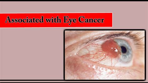 Understand The Risk Factors Associated With Eye Cancer