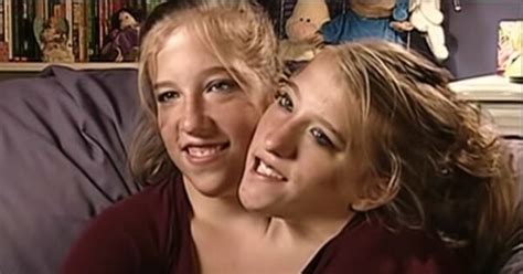 Conjoined Twins Abby And Brittany Friendsrewa