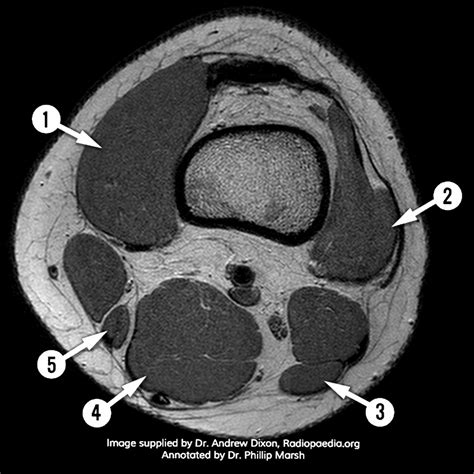 Knee Muscle Anatomy Axial Mri Mri Knee Axial Anatomy Quiz Radiology Case Radiopaedia Org