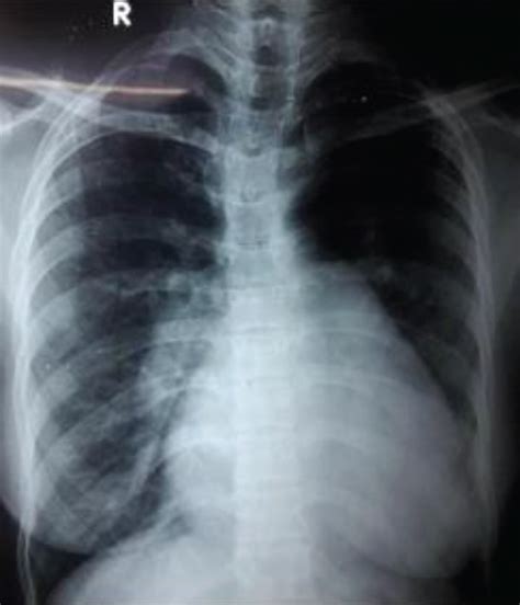 Chest X Ray Pa View Showing Bulged Pulmonary Conus Cardiomegaly And