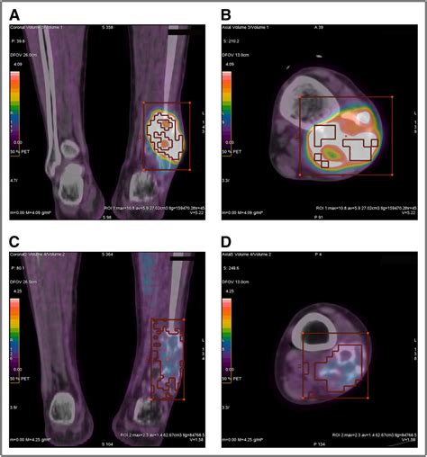 18f Fdg Petct As An Indicator Of Progression Free And Overall Survival