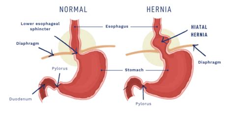 Hiatal Hernia Syndrome Nourishing Therapies