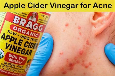 The Benefits Offered By Apple Cider Vinegar Acne Treatment Solution