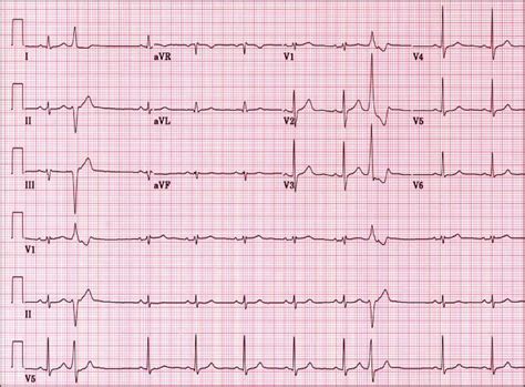 Electrocardiography in clinical practice, n. EKG | Diabetes & Endocrinology Specialists