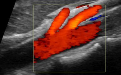 Inferior Mesenteric Artery Ultrasound