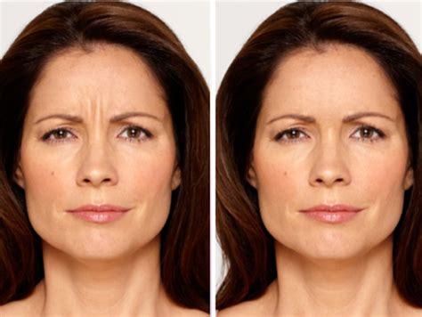 How long does it take for botox lip flip to kick in. Preview How You Will Look With Botox With iVisualizer App ...