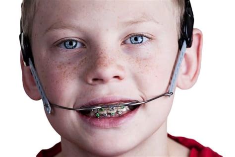 What Is Orthodontic Headgear And How Is It Used